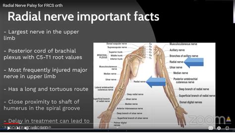 radial nerve compression test|symptoms of radial nerve compression.